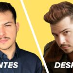 ¿Qué Debes Saber Antes de Hacerte un Injerto Capilar?