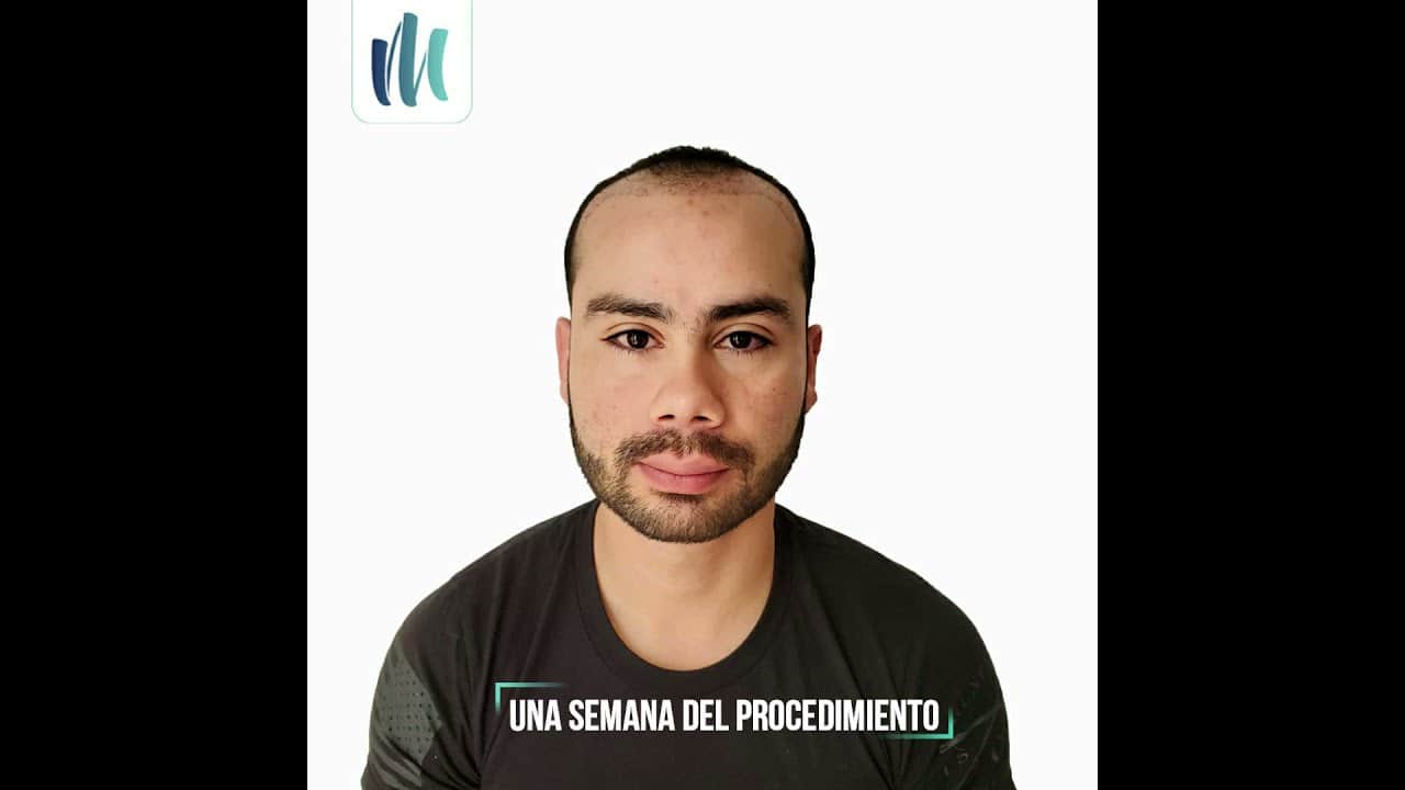 Estilo de Vida y Injerto Capilar: Cómo Maximizar tus Resultados