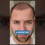 Por Qué el Injerto Capilar es Más Accesible de lo que Crees